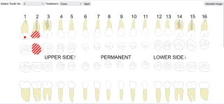 Dental Implants Tool